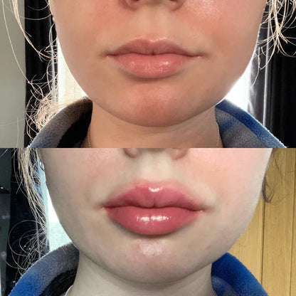 Plump It! No Needles Lip Filler Kit Original